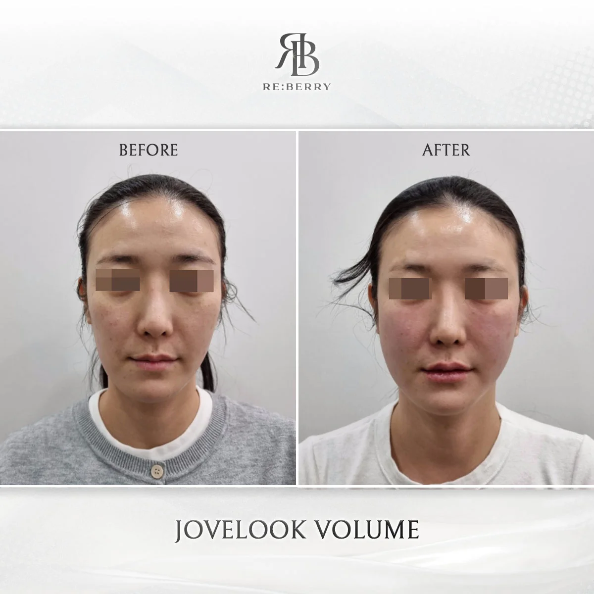 Juvelook Volume - Facial Volume
